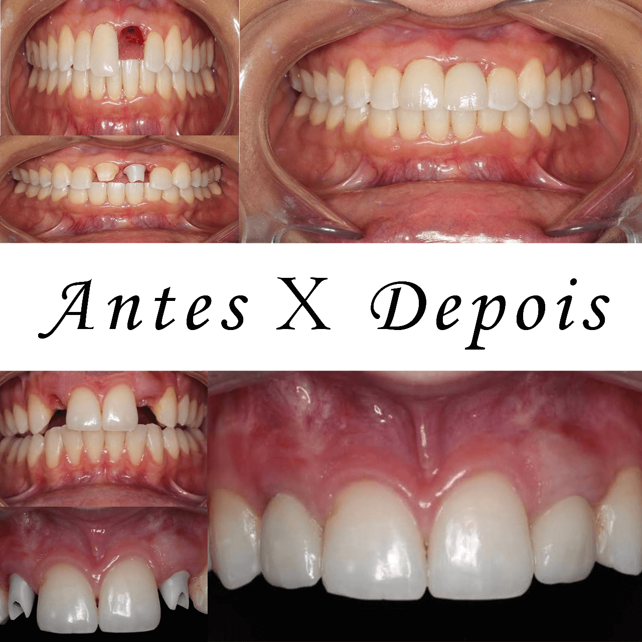 Antes X Depois 1
